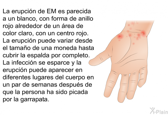 La erupcin de EM es parecida a un blanco, con forma de anillo rojo alrededor de un rea de color claro, con un centro rojo. La erupcin puede variar desde el tamao de una moneda hasta cubrir la espalda por completo. La infeccin se esparce y la erupcin puede aparecer en diferentes lugares del cuerpo en un par de semanas despus de que la persona ha sido picada por la garrapata.