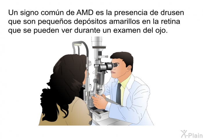 Un signo comn de AMD es la presencia de <I>drusen</I> que son pequeos depsitos amarillos en la retina que se pueden ver durante un examen del ojo.