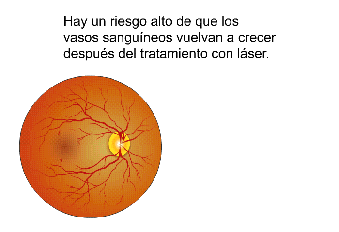 Hay un riesgo alto de que los vasos sanguneos vuelvan a crecer despus del tratamiento con lser.