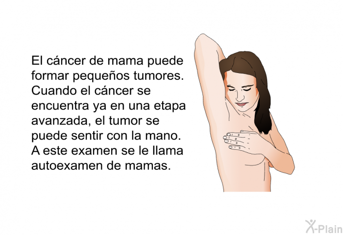 El cncer de mama puede formar pequeos tumores. Cuando el cncer se encuentra ya en una etapa avanzada, el tumor se puede sentir con la mano. A este examen se le llama autoexamen de mamas.