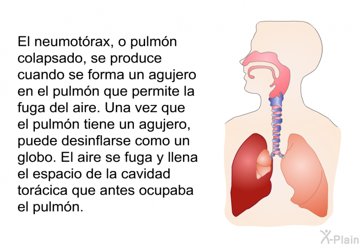 El neumotrax, o pulmn colapsado, se produce cuando se forma un agujero en el pulmn que permite la fuga del aire. Una vez que el pulmn tiene un agujero, puede desinflarse como un globo. El aire se fuga y llena el espacio de la cavidad torcica que antes ocupaba el pulmn.