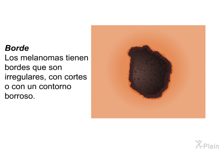 <B>Borde:</B> Los melanomas tienen bordes que son irregulares, con cortes o con un contorno borroso.