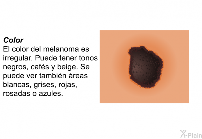 <B>Color:</B> El color del melanoma es irregular. Puede tener tonos negros, caf�s y beige. Se puede ver tambi�n �reas blancas, grises, rojas, rosadas o azules.