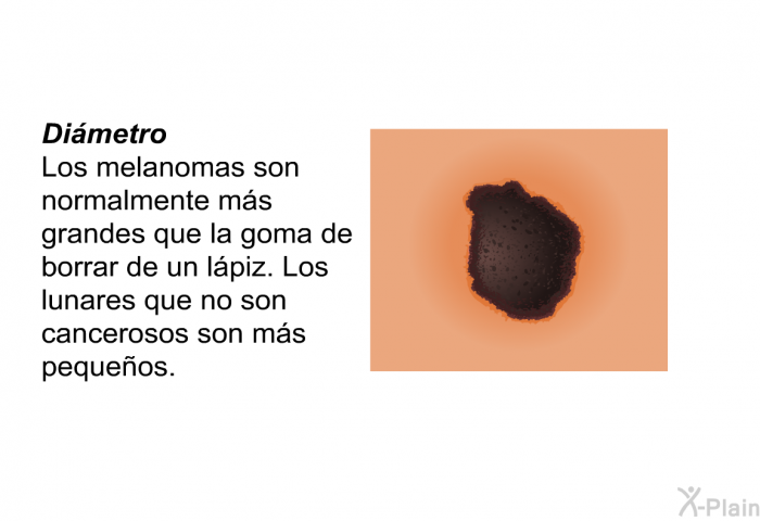 <B>Di�metro:</B> Los melanomas son normalmente m�s grandes que la goma de borrar de un l�piz. Los lunares que no son cancerosos son m�s peque�os.