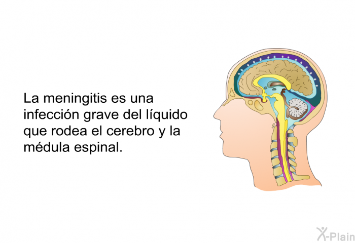 La meningitis es una infeccin grave del lquido que rodea el cerebro y la mdula espinal.