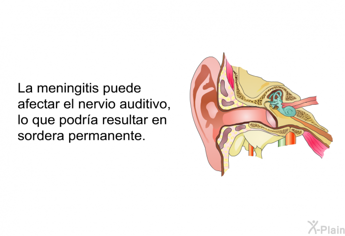 La meningitis puede afectar el nervio auditivo, lo que podra resultar en sordera permanente.