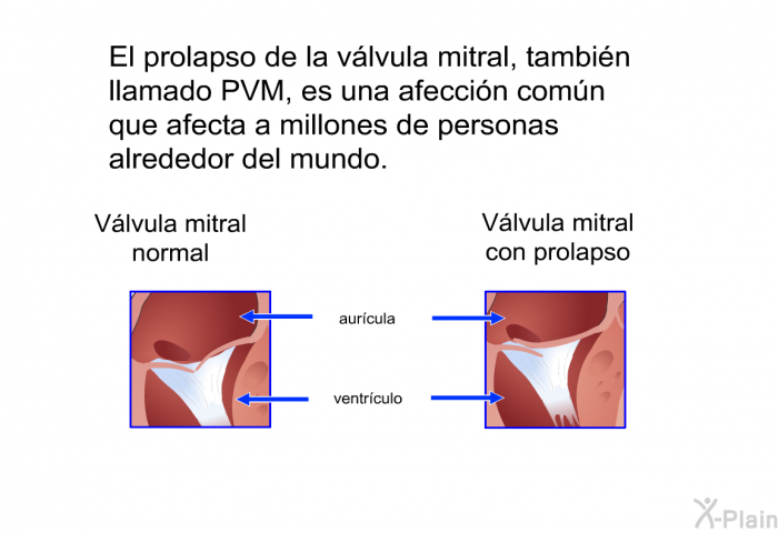 El prolapso de la vlvula mitral, tambin llamado PVM, es una afeccin comn que afecta a millones de personas alrededor del mundo.