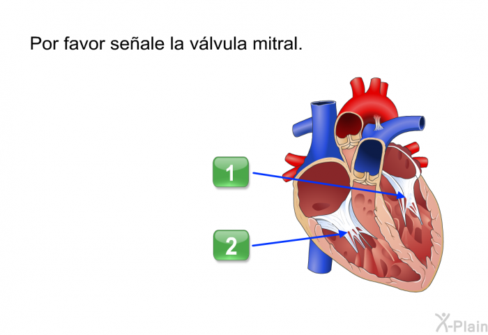 Por favor seale la vlvula mitral.