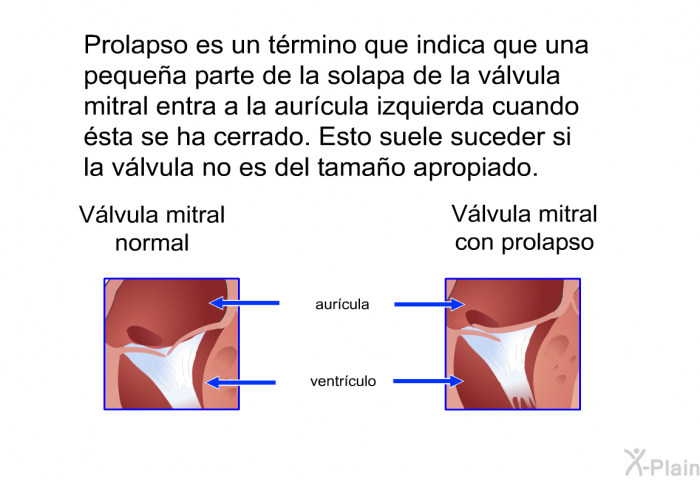 Prolapso es un trmino que indica que una pequea parte de la solapa de la vlvula mitral entra a la aurcula izquierda cuando sta se ha cerrado. Esto suele suceder si la vlvula no es del tamao apropiado.