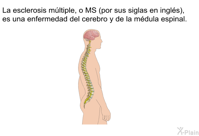 La esclerosis mltiple, o MS (por sus siglas en ingls), es una enfermedad del cerebro y de la mdula espinal.