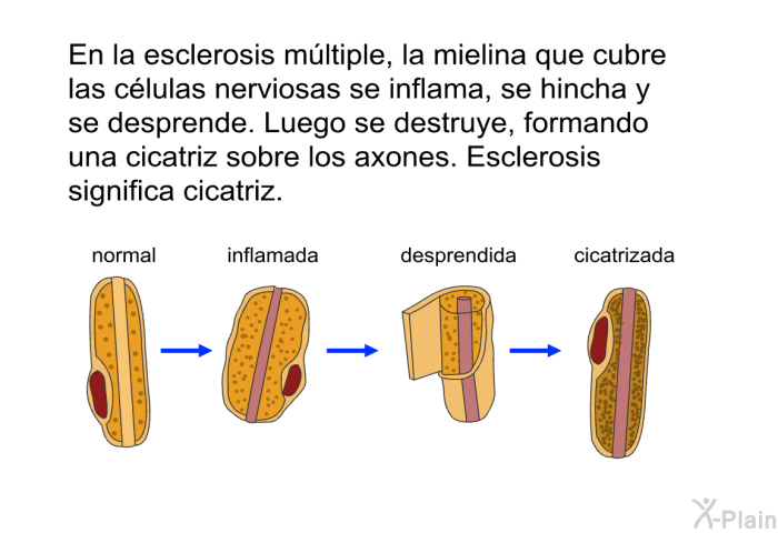 En la esclerosis mltiple, la mielina que cubre las clulas nerviosas se inflama, se hincha y se desprende. Luego se destruye, formando una cicatriz sobre los axones. Esclerosis significa <I>cicatriz</I>.