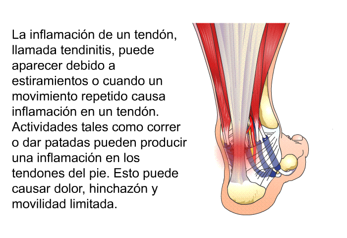 La inflamacin de un tendn, llamada tendinitis, puede aparecer debido a estiramientos o cuando un movimiento repetido causa inflamacin en un tendn. Actividades tales como correr o dar patadas pueden producir una inflamacin en los tendones del pie. Esto puede causar dolor, hinchazn y movilidad limitada.