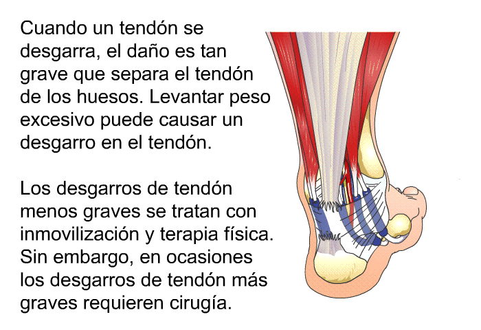 Cuando un tendn se desgarra, el dao es tan grave que separa el tendn de los huesos. Levantar peso excesivo puede causar un desgarro en el tendn. Los desgarros de tendn menos graves se tratan con inmovilizacin y terapia fsica. Sin embargo, en ocasiones los desgarros de tendn ms graves requieren ciruga.