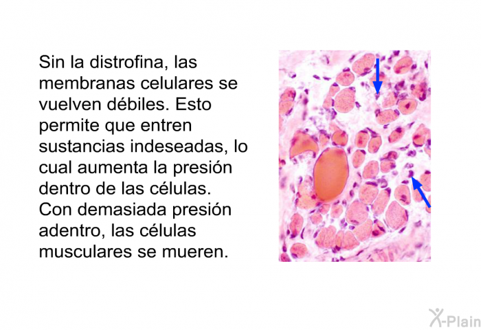 Sin la distrofina, las membranas celulares se vuelven dbiles. Esto permite que entren sustancias indeseadas, lo cual aumenta la presin dentro de las clulas. Con demasiada presin adentro, las clulas musculares se mueren.