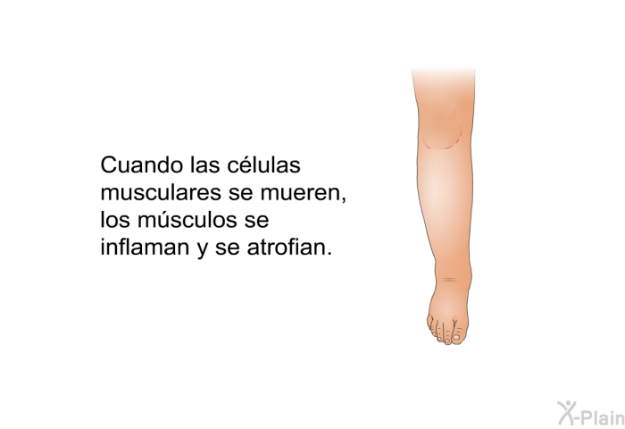 Cuando las clulas musculares se mueren, los msculos se inflaman y se atrofian.
