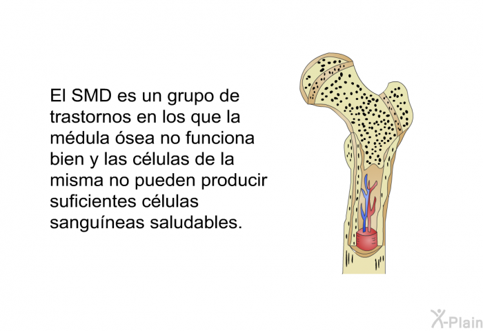El SMD es un grupo de trastornos en los que la mdula sea no funciona bien y las clulas de la misma no pueden producir suficientes clulas sanguneas saludables.