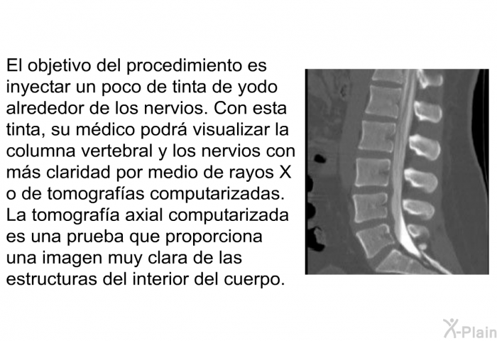 El objetivo del procedimiento es inyectar un poco de tinta de yodo alrededor de los nervios. Con esta tinta, su mdico podr visualizar la columna vertebral y los nervios con ms claridad por medio de rayos X o de tomografas computarizadas. La tomografa axial computarizada es una prueba que proporciona una imagen muy clara de las estructuras del interior del cuerpo.