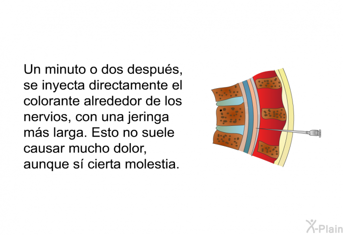 Un minuto o dos despus, se inyecta directamente el colorante alrededor de los nervios, con una jeringa ms larga. Esto no suele causar mucho dolor, aunque s cierta molestia.