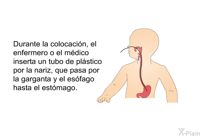 Durante la colocacin, el enfermero o el mdico inserta un tubo de plstico por la nariz, que pasa por la garganta y el esfago hasta el estmago.