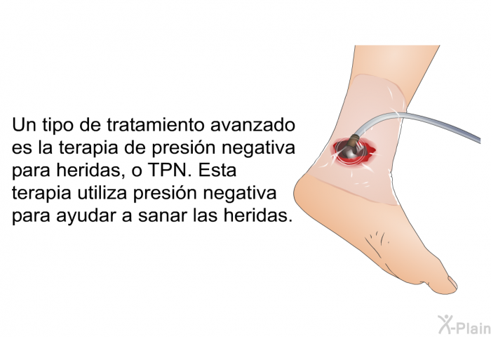 Un tipo de tratamiento avanzado es la terapia de presin negativa para heridas, o TPN. Esta terapia utiliza presin negativa para ayudar a sanar las heridas.