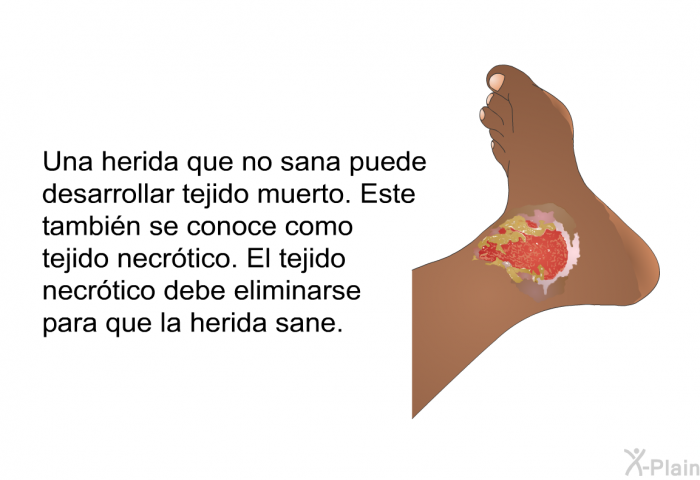 Una herida que no sana puede desarrollar tejido muerto. Este tambin se conoce como tejido necrtico. El tejido necrtico debe eliminarse para que la herida sane.