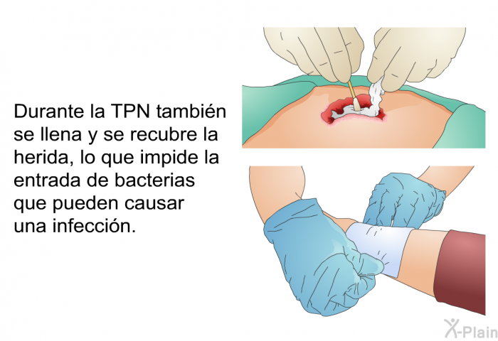 Durante la TPN tambin se llena y se recubre la herida, lo que impide la entrada de bacterias que pueden causar una infeccin.