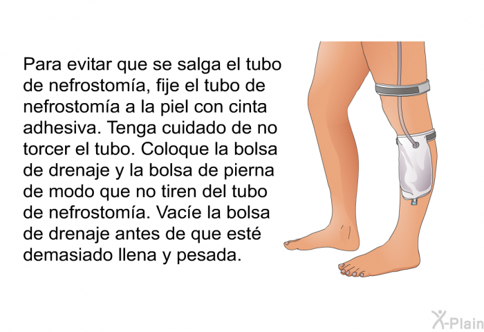 Para evitar que se salga el tubo de nefrostom�a, fije el tubo de nefrostom�a a la piel con cinta adhesiva. Tenga cuidado de no torcer el tubo. Coloque la bolsa de drenaje y la bolsa de pierna de modo que no tiren del tubo de nefrostom�a. Vac�e la bolsa de drenaje antes de que est� demasiado llena y pesada.