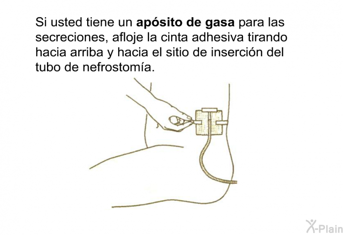 Si usted tiene un<B> ap�sito de gasa</B> para las secreciones, afloje la cinta adhesiva tirando hacia arriba y hacia el sitio de inserci�n del tubo de nefrostom�a.