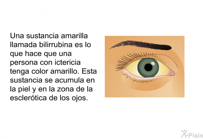 Una sustancia amarilla llamada bilirrubina es lo que hace que una persona con ictericia tenga color amarillo. Esta sustancia se acumula en la piel y en la zona de la esclertica de los ojos.