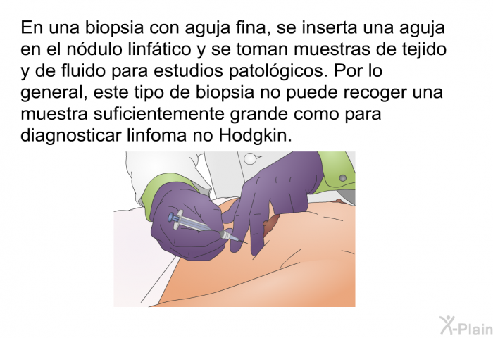 En una biopsia con aguja fina, se inserta una aguja en el ndulo linftico y se toman muestras de tejido y de fluido para estudios patolgicos. Por lo general, este tipo de biopsia no puede recoger una muestra suficientemente grande como para diagnosticar linfoma no Hodgkin.