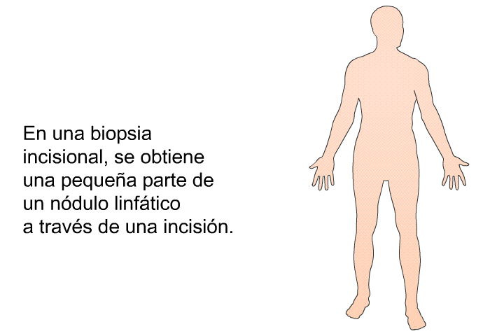 En una biopsia incisional, se obtiene una pequea parte de un ndulo linftico a travs de una incisin.