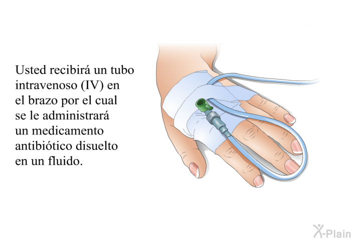 Usted recibir un tubo intravenoso (IV) en el brazo por el cual se le administrar un medicamento antibitico disuelto en un fluido.