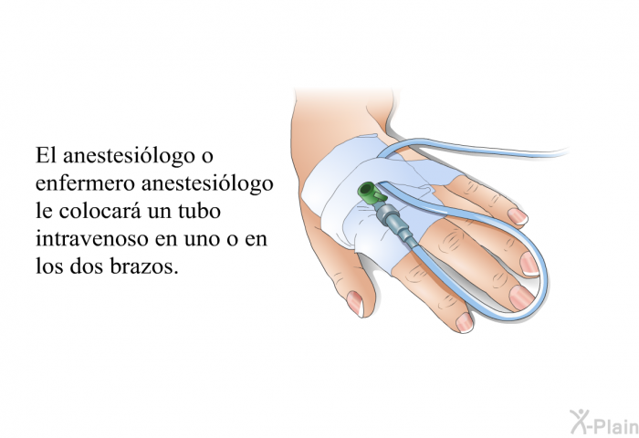 El anestesilogo o enfermero anestesilogo le colocar un tubo intravenoso en uno o en los dos brazos.
