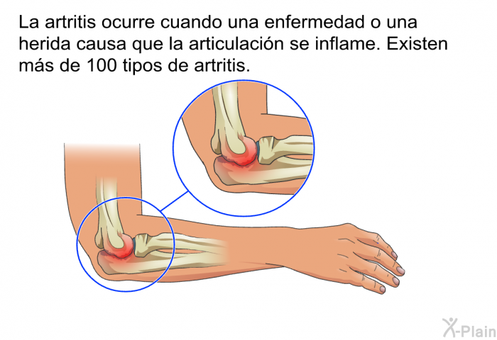 La artritis ocurre cuando una enfermedad o una herida causa que la articulacin se inflame. Existen ms de 100 tipos de artritis.