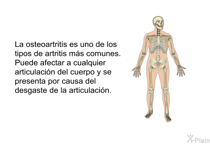 La osteoartritis es uno de los tipos de artritis ms comunes. Puede afectar a cualquier articulacin del cuerpo y se presenta por causa del desgaste de la articulacin.