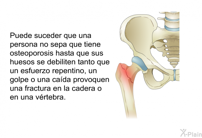 Puede suceder que una persona no sepa que tiene osteoporosis hasta que sus huesos se debiliten tanto que un esfuerzo repentino, un golpe o una cada provoquen una fractura en la cadera o en una vrtebra.