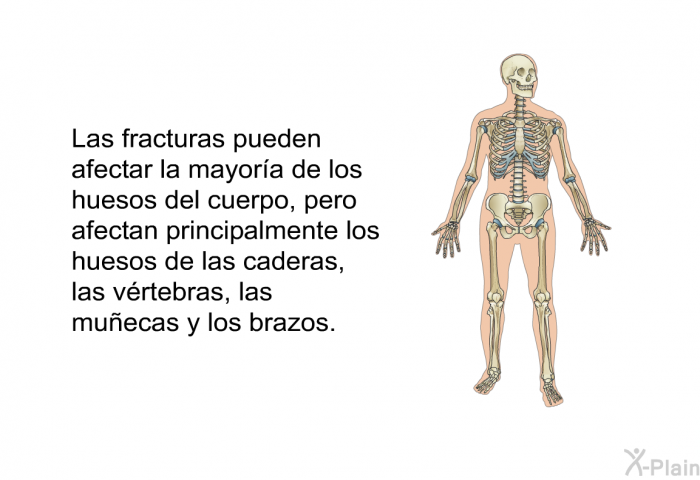Las fracturas pueden afectar la mayora de los huesos del cuerpo, pero afectan principalmente los huesos de las caderas, las vrtebras, las muecas y los brazos.