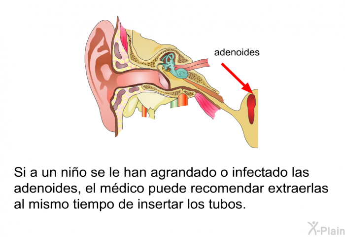 Si a un ni�o se le han agrandado o infectado las adenoides, el m�dico puede recomendar extraerlas al mismo tiempo de insertar los tubos. &nbsp;