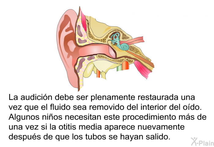 La audici�n debe ser plenamente restaurada una vez que el fluido sea removido del interior del o�do. Algunos ni�os necesitan este procedimiento m�s de una vez si la otitis media aparece nuevamente despu�s de que los tubos se hayan salido.&nbsp;
