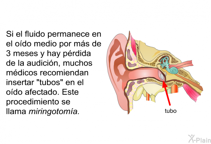 Si el fluido&nbsp;permanece en el o�do medio por m�s de 3 meses y hay p�rdida de la audici�n, muchos m�dicos recomiendan insertar &ldquo;tubos&rdquo; en el o�do afectado. Este procedimiento se llama <I>miringotom�a</I>.