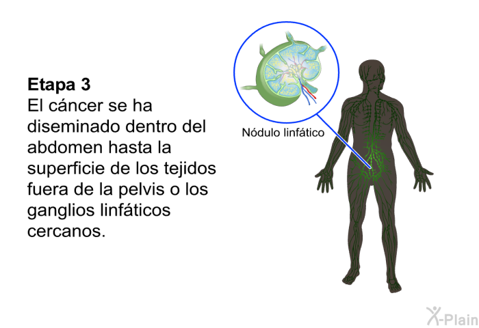 Etapa 3: El c�ncer se ha diseminado dentro del abdomen hasta la superficie de los tejidos fuera de la pelvis o los ganglios linf�ticos cercanos.