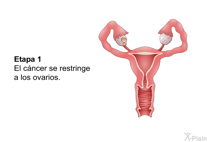 Etapa 1: El c�ncer se restringe a los ovarios.