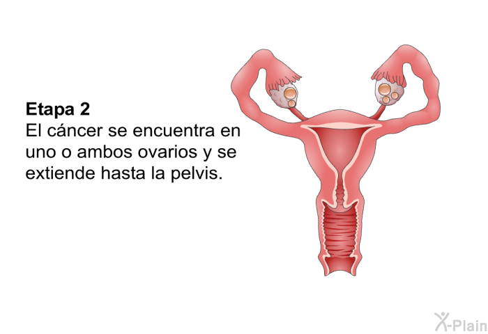 Etapa 2: El c�ncer se encuentra en uno o ambos ovarios y se extiende hasta la pelvis.