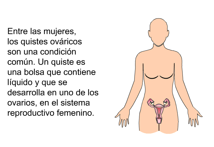 Entre las mujeres, los quistes ovricos son una condicin comn. Un quiste es una bolsa que contiene lquido y que se desarrolla en uno de los ovarios, en el sistema reproductivo femenino.