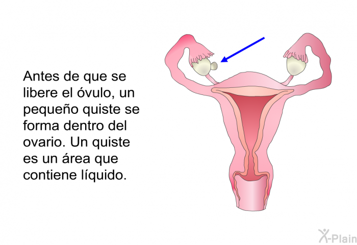 Antes de que se libere el vulo, un pequeo quiste se forma dentro del ovario. Un quiste es un rea que contiene lquido. 