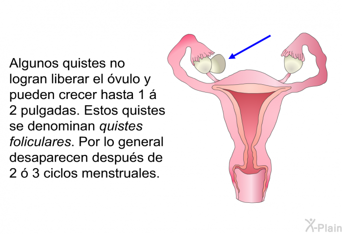 Algunos quistes no logran liberar el vulo y pueden crecer hasta 1 a 2 pulgadas. Estos quistes se denominan quistes foliculares. Por lo general desaparecen despus de 2  3 ciclos menstruales. 