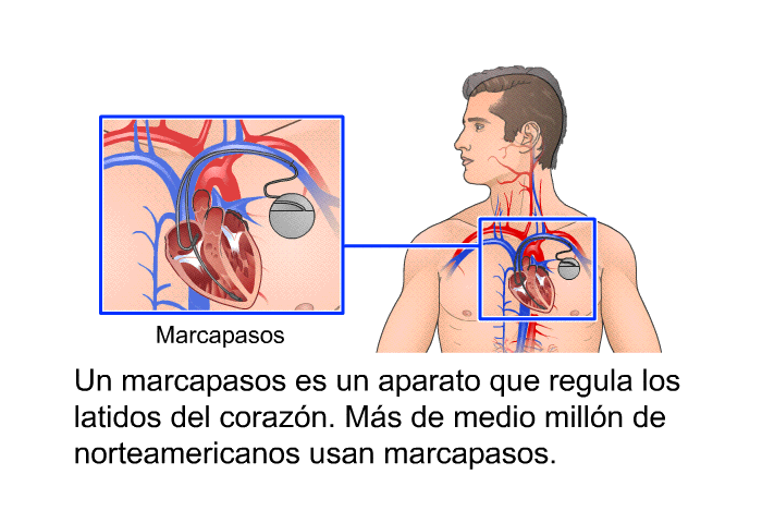 Un marcapasos es un aparato que regula los latidos del corazn. Ms de medio milln de norteamericanos usan marcapasos.