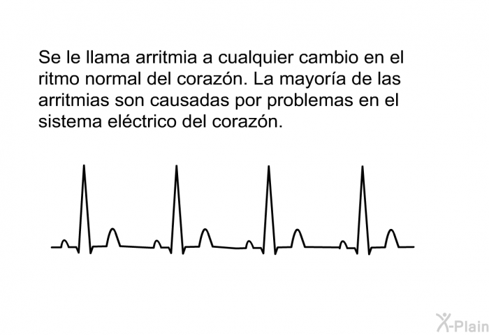 Se le llama arritmia a cualquier cambio en el ritmo normal del corazn. La mayora de las arritmias son causadas por problemas en el sistema elctrico del corazn.