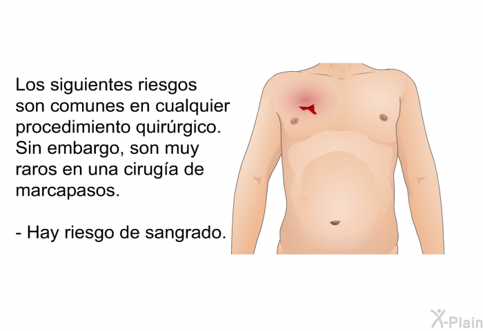 Los siguientes riesgos son comunes en cualquier procedimiento quirrgico. Sin embargo, son muy raros en una ciruga de marcapasos. Hay riesgo de sangrado.