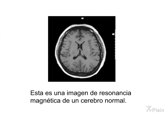 Esta es una imagen de resonancia magntica de un cerebro normal.